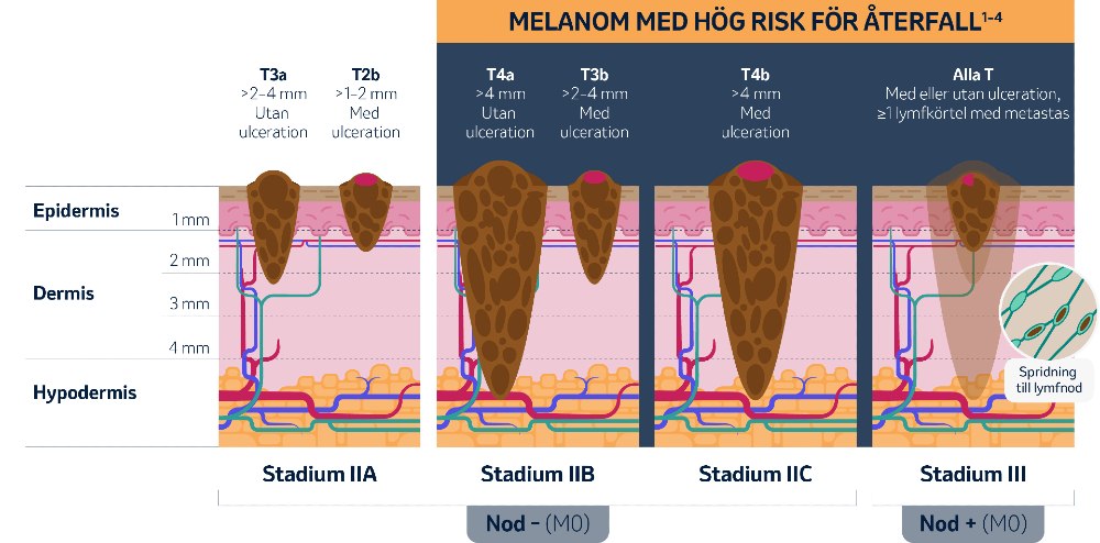 Melanom - Risken för återfall efter total resektion är hög för melanom både vid stadium IIB och IIC