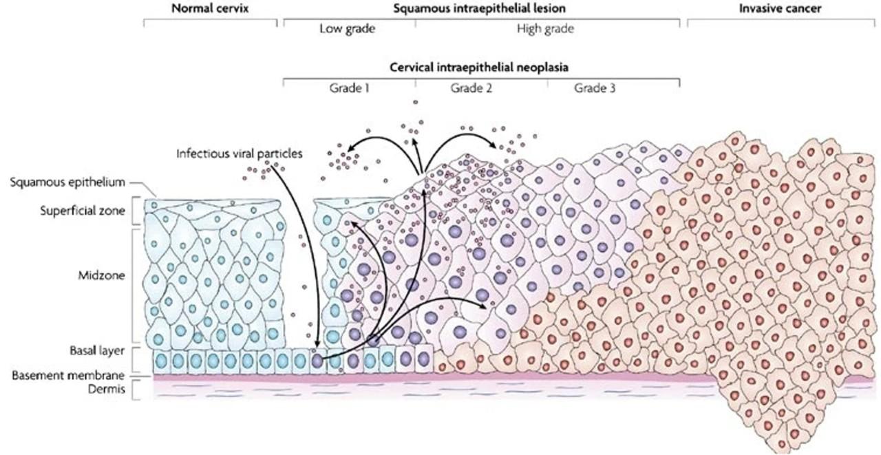 HPV-screening - Cellförändringar på livmoderhalsen