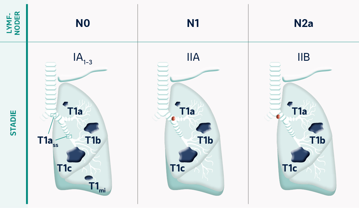 TNM Klassifikation av tumörstadier vid tumörstorlek T1