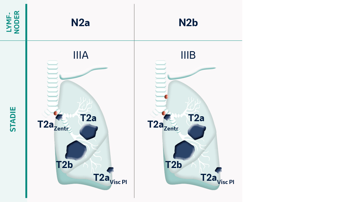 TNM Klassifikation av tumörstadier vid tumörstorlek T2