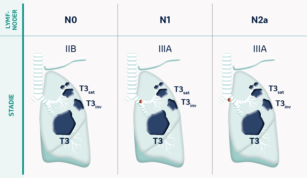 TNM Klassifikation av tumörstadier vid tumörstorlek T3