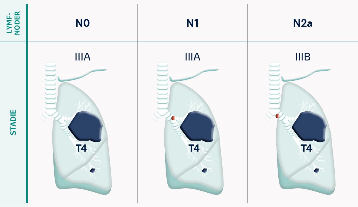 TNM Klassifikation av tumörstadier vid tumörstorlek T4