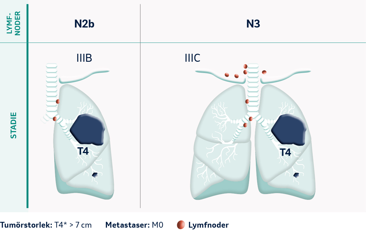 TNM Klassifikation av tumörstadier vid tumörstorlek T4